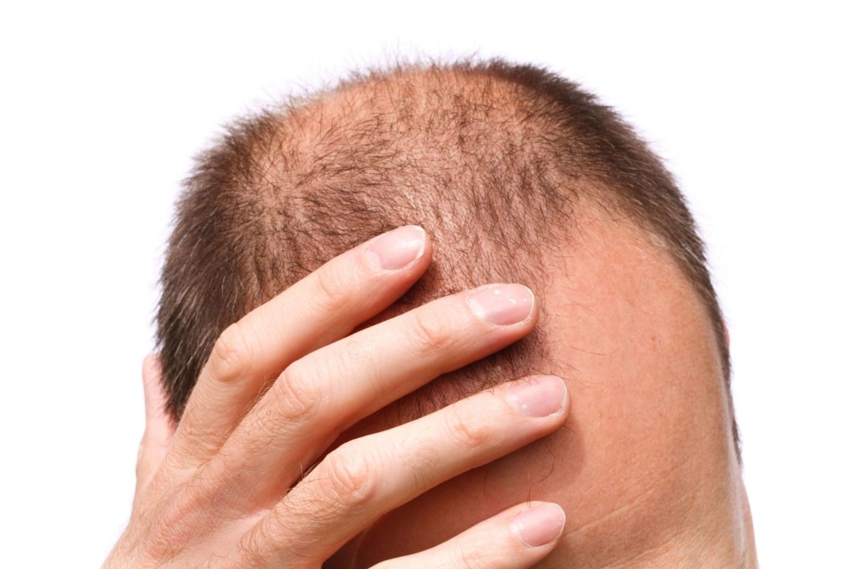 علاج تساقط الشعر للرجال