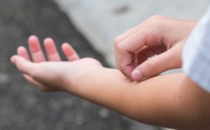 حساسية الجلد عند الأطفال من الأكل