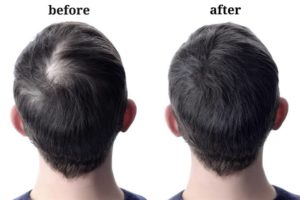 عمليات زراعة الشعر للرأس