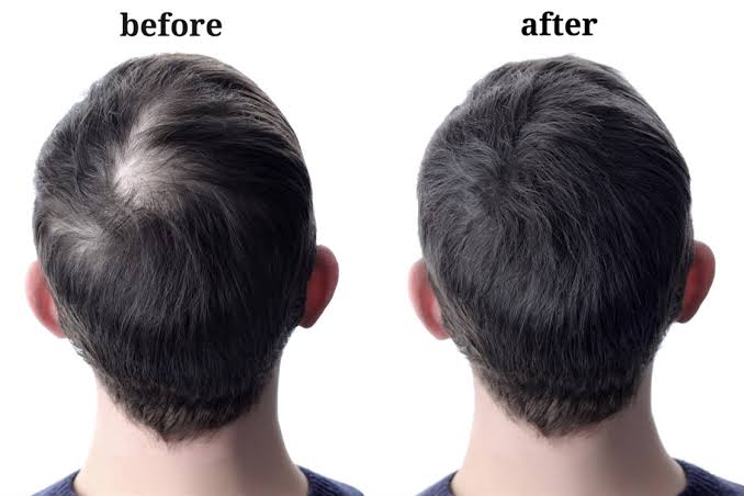 عمليات زراعة الشعر للرأس
