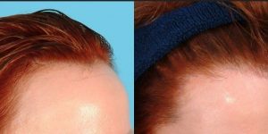 عمليات زراعة الشعر للرأس